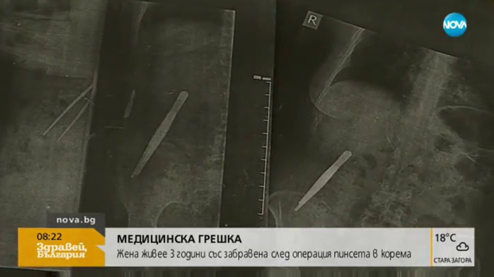 Резултат с изображение за Българка живее 3 г. със забравена след операция пинсета в корема